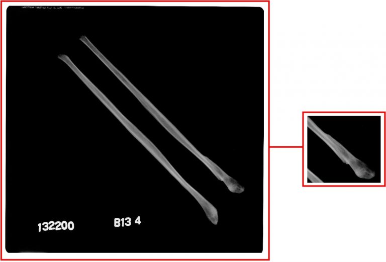 X-ray of right and left fibulae with the fracture clearly visible on the lower part of the left bone.